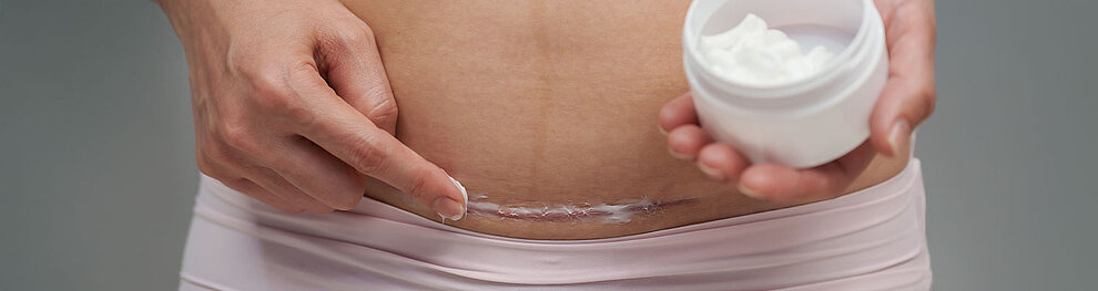 Eine Person trägt eine Creme auf eine Narbe auf ihrem Bauch auf.