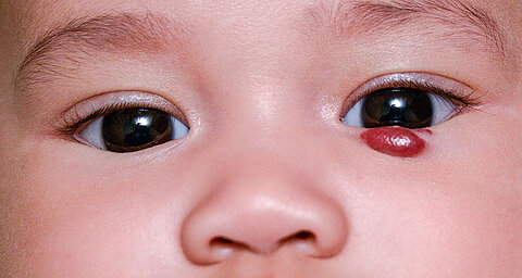 Nahaufnahme des Gesichts eines Kindes mit einem Blutfleck in der Nähe des rechten Auges.